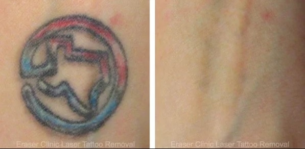 Eraser Clinic Laser Tattoo Removal Image