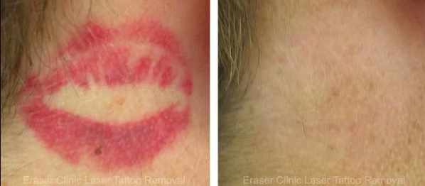 Eraser Clinic Laser Tattoo Removal Image