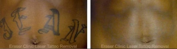 Eraser Clinic Laser Tattoo Removal Image