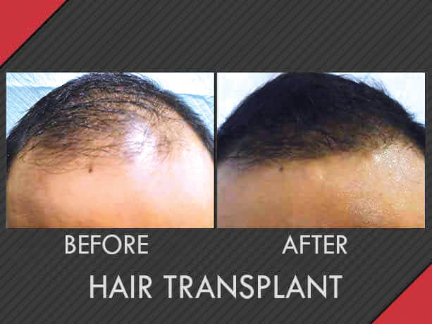 MAXIM Hair Restoration Image