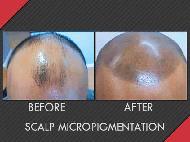 MAXIM Hair Restoration Image