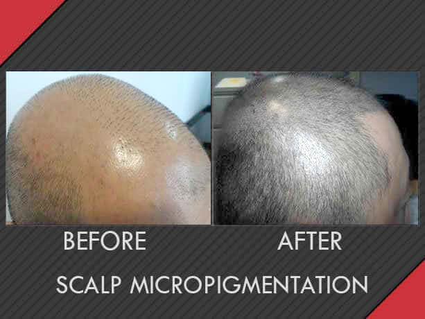 MAXIM Hair Restoration Image