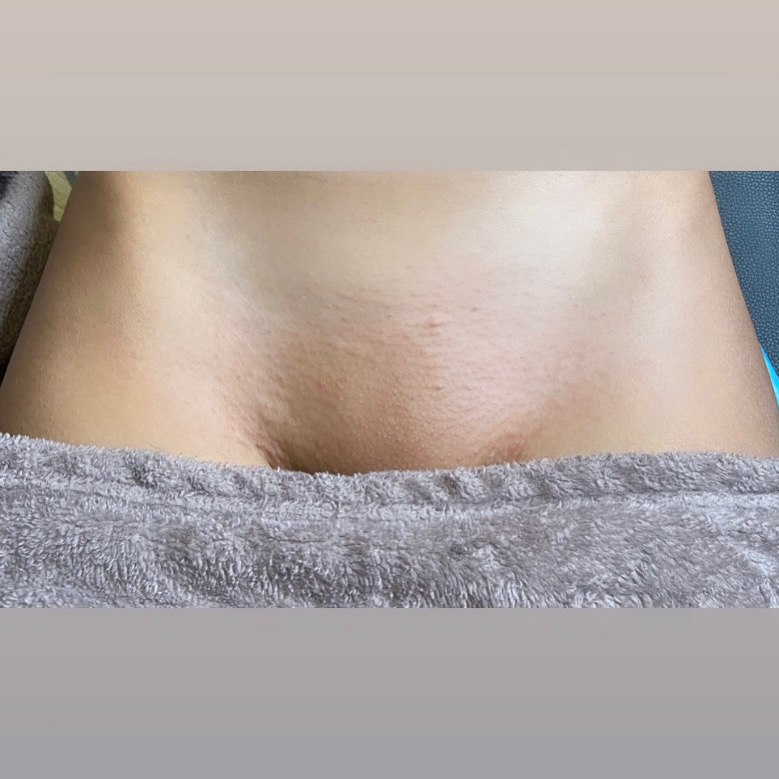 After of a Brazilian/Bikini Full Wax