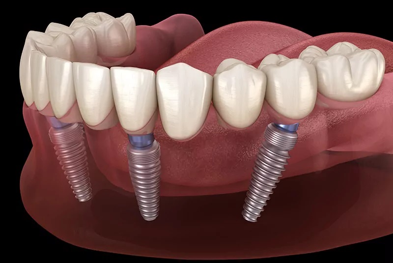 Dental Implants Phoenix Image